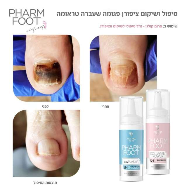 נוזל קולוסטרום לשיקום הציפורן לטיפול באוניכוליזיס פארם פוט onyPLASMA PHARM FOOT מכיל 15 מ"ל